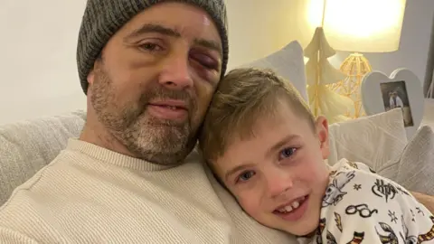 Tom sitting on a sofa with Oliver resting against him. Tom's left eye is swollen shut and bruised. He is wearing a knitted beanie and a light-colored top, while Oliver is dressed in patterned pajamas. A warm table lamp glows in the background, casting soft light across the room.