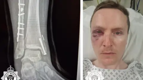 West Mercia Police A black and white x-ray of a bone and a man with short brown hair with bruises around his eye. He is wearing a white patterned top.