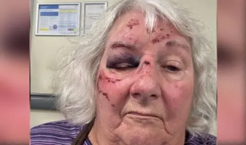 Christine Reid's face framed with grey hair, showing injuries from falling over on the uneven pavements. She has cuts to her forehead, nose and cheek with a bruise over her right eye.