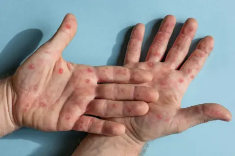 Getty Images Close up image of adult, male hands featuring mpox infection - red blister spots are visible. Hands are placed on a blue background