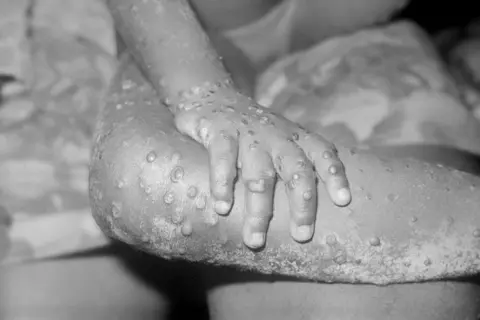 Getty Images/BSIP Monkeypox