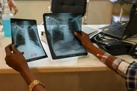 Getty Images In this picture taken on March 22, 2022, Gautam Kamble, who is diagnosed with tuberculosis, holds chest x-rays during a routine consultation with a doctor at the Médecins Sans Frontières (MSF) clinic, which treats people with drug-resistant tuberculosis, in Mumbai.