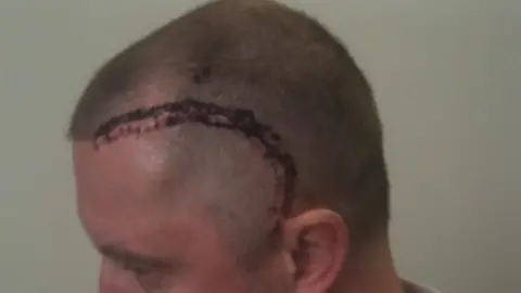 Steve Rhodes Steve Rhodes is 42 in the image and you can just see his head and shoulders. His head has been shaved and there is a very long cut in a semi-circle which has been stitched.