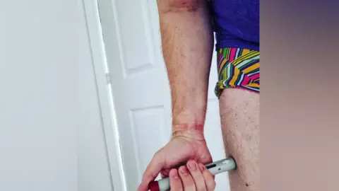 Joel Nelson A person with skin rashes injecting their leg with a medical pen and needle