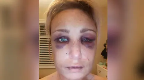 Katie Yates Katie Yates is looking at the camera with two black eyes and a swollen face