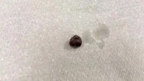 Handley Family Small black ball - a raisin - on a white napkin after being removed from Peyton Handley's nose