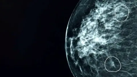 AI tool Mia circles two areas of concern on a mammogram scan.