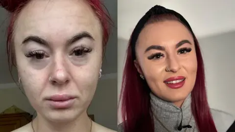 Casey Innalls before and after treatment for ketamine addiction.