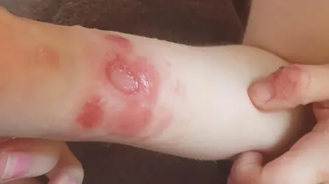 FAMILY HANDOUT A child's arm showing reddened inflamed, and broken skin because of eczema