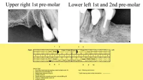 North Wales Police X-rays of teeth inside of a man, with descriptions of the type of procedure and condition.