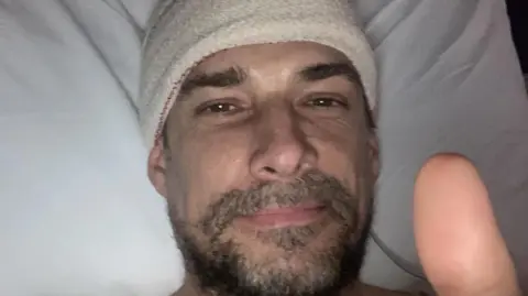 A man with a beard and a bandaged head is giving a thumbs up to the camera while lying in a hospital bed. 