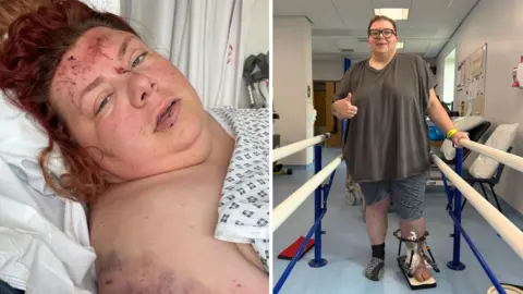 Natalia is at a physio rehab centre, stood between parallel bars to help her walk. Her left leg is in a metal cage. She makes a thumbs up pose to the camera. 