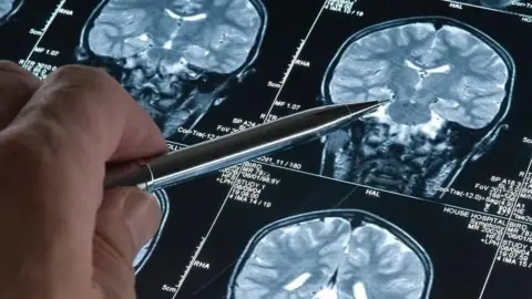 Getty Images A hand holding a pen points at a sheet of brain scan results. 