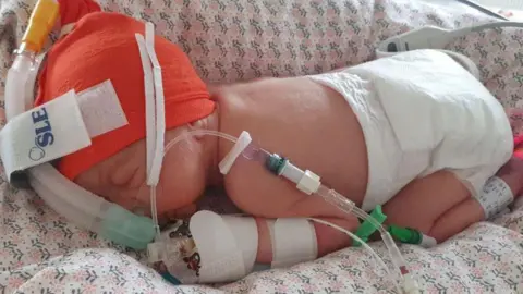 A baby in a neonatal intensive care unit.