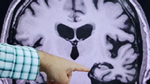 BBC Alzheimer's disease