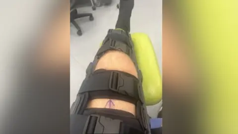 Joel Collins Joel Collins' injured leg is seen in a cast in hospital