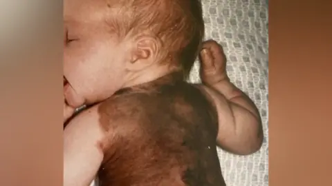 Jodi Whitehouse Jodi Whitehouse as a baby with the dark brown CMN shown covering her back. She is lying on her front with her mouth slightly open as if suckling. 
Her right arm is bent at the elbow with her fist resting beside the back of her head.