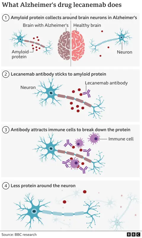 How the drug lecanemab slows the progression of Alzheimer's disease