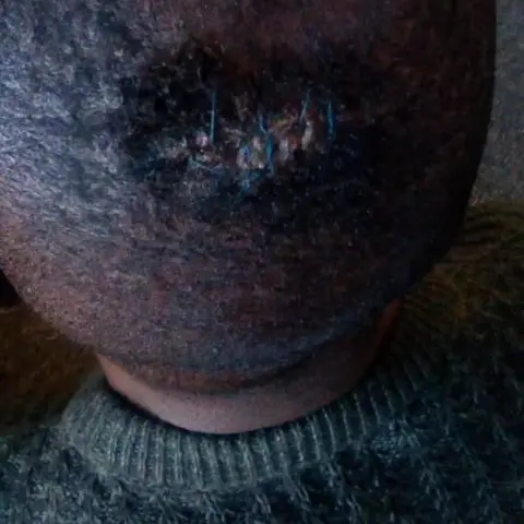 Wound with stitches on top of a man's head