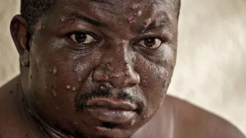 Mercy Juma / BBC A man who has mpox on his face