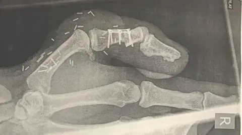 Supplied An X-ray of the toe thumb post surgery
