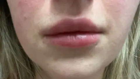 A close-up of Bekki's lips after the procedure. She has blond hair and her lips look uneven. 