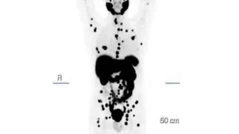 Handout A hospital scan of Mr Gibson's body, which shows a faint grey outline of his figure. Within that shape are various black spots which indicate the cancer cells breaking apart and spreading through his body.