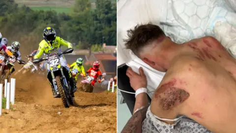Calum Mitchell A composite image of Calum Mitchell. On the left he is racing on a motocross bike and on the right it is an image of injuries to his back from a motocross crash.