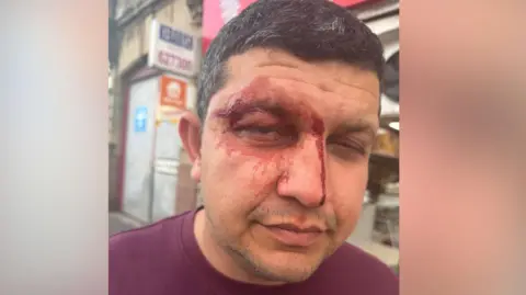 Dr Zohaib Arshad standing outside on a street with a facial injury above his left eye, with blood visible around the eye and down the side of his nose following the reported assault in Falkirk.