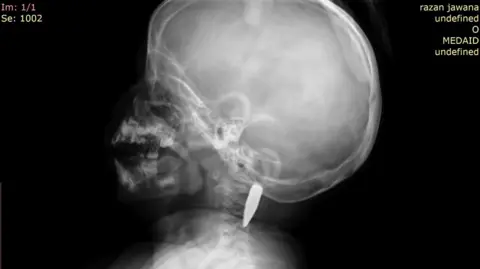 UK-Med A CT scan image which shows a small child's skeleton (Razan's) with a bullet lodged in the neck