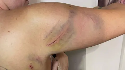 Sarah Bound Bruises and scratches on Sarah's right arm