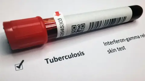 A vial filled with blood. It has a red cap and a white sticker with a barcode. The vial is sat on a piece of paperwork. Below is there is a line with a ticked box that says Tuberculosis. 