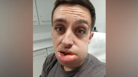 Jack Cope Jack Cope is sitting on a white hospital bed in a clinical room. He has short brown hair and is wearing a grey T-shirt. The left side of his face (the right when looking at the image) is swollen, including his lip.