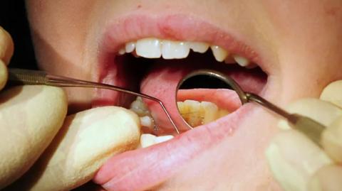 A close up of a dental patient's mouth as they undergo an examination