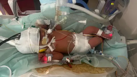 PA Media A newborn child in a hospital cot with medial equipment on her body.