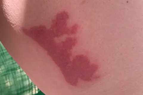 Denise Elliott A large bright red splotch scald mark on Denise's thigh.