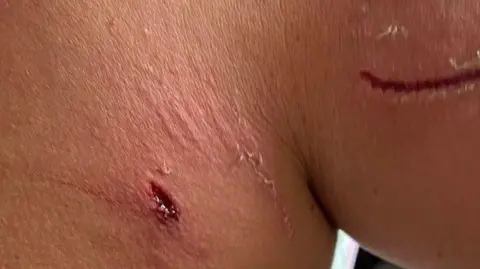 Sarah Bound The puncture wounds on Sarah's back and arm