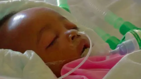 Baby Samantha Bindu is pictured in hospital in 2017. She has a pelvis extending from her nose and other tubes to her side. She is covered with a pink blanket