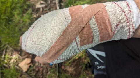 A bandaged hand after Mr Ramirez says he was attacked by a dog