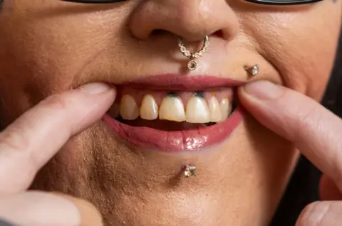 Stacey holds back her top lip with her index fingers showing white top teeth but with dark holes in her gums above the two front incisors . she has a diamond stud in her lower and upper lip and an ornate gold ring in her nose