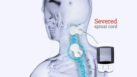 MHAIRI FRASER/BBC A graphic showing electrodes placed on the neck of a male trial participant. The graphic shows the patient's spinal column. There are pads on the end of wires, which are stuck to the outside of the skin. Wires then flow into an external control box which directs the intensity of the pulses.