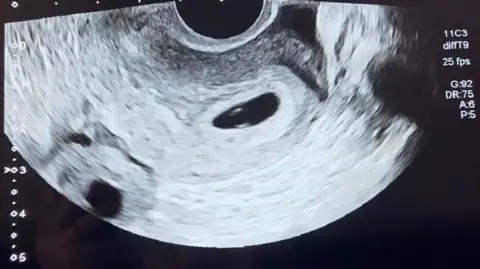 Lucy Ness A baby scan picture 