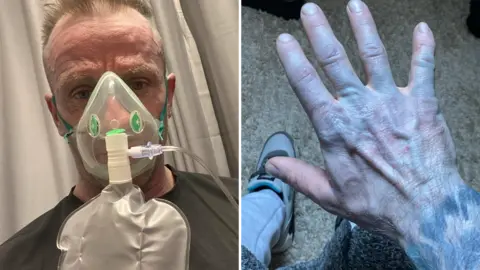 Scott Lynch/SWNS Split picture of Scott Lynch wearing an oxygen mask and another pic of his blue hand