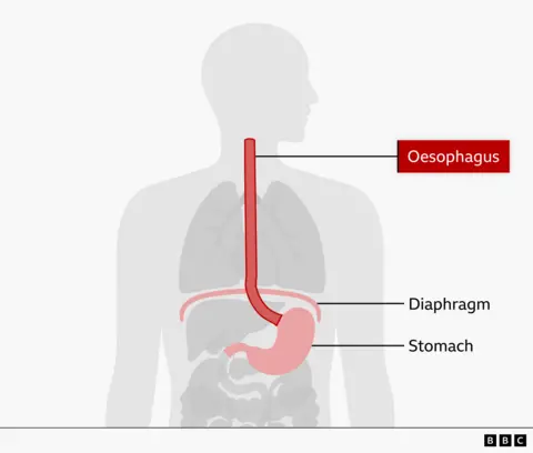 Anatomical sketch showing nan normal position of nan oesophagus
