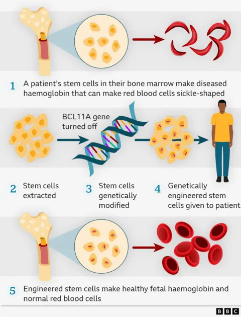 Graphic explaining how the gene therapy works in 5 steps with illustrations. 1) A patient's stem cells in their bone marrow make diseased haemoglobin that can make red blood cells sickle-shaped. 2) Stem cells extracted, and BCL11A gene turned off. 3) Stem cells genetically modified. 4) Genetically engineered stem cells given to patient. 5) Engineered stem cells make healthy fetal haemoglobin and normal red blood cells. 