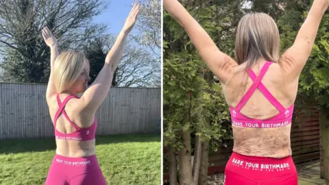 Caring Matters Now Two side-by-side images of women stood outside with large, light brown birthmarks across their backs, wearing sports-bra type tops and gym shorts. 