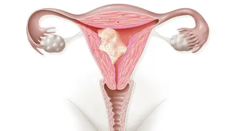 Getty Images An illustration of a womb with a cancer tumour growing within it.