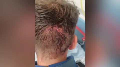 North Yorkshire Police The back of someone's head with stitches and a long, bloody scar in the shape of a worm. 