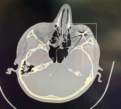 Obtained by BBC News Persian An exclusive CT-scan image obtained by BBC News Persian shows a metal pellet embedded in a Mashad protester's right eyeball.
