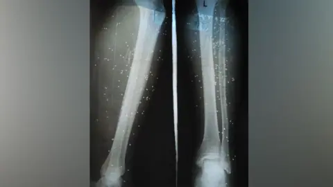 BBC An X-ray showing birdshot in the legs of a wounded protester in Iran